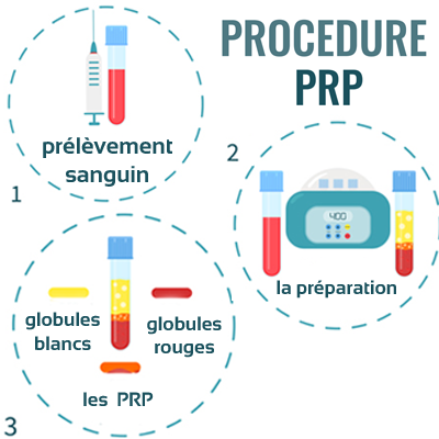 process prp.png